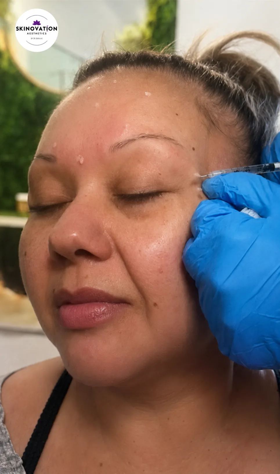 Botox treatment