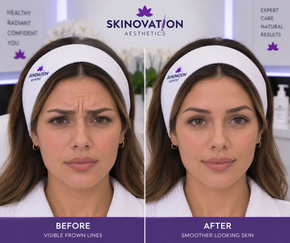 Patient's frown lines softened after Botox treatment at Skinovation Aesthetics in Katy, TX