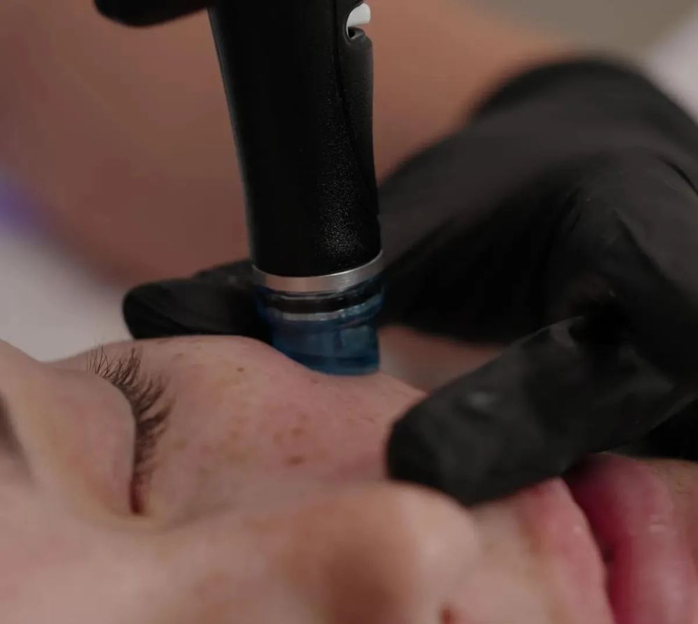 Vortex-Fusion HydraFacial handpiece cleansing and hydrating skin