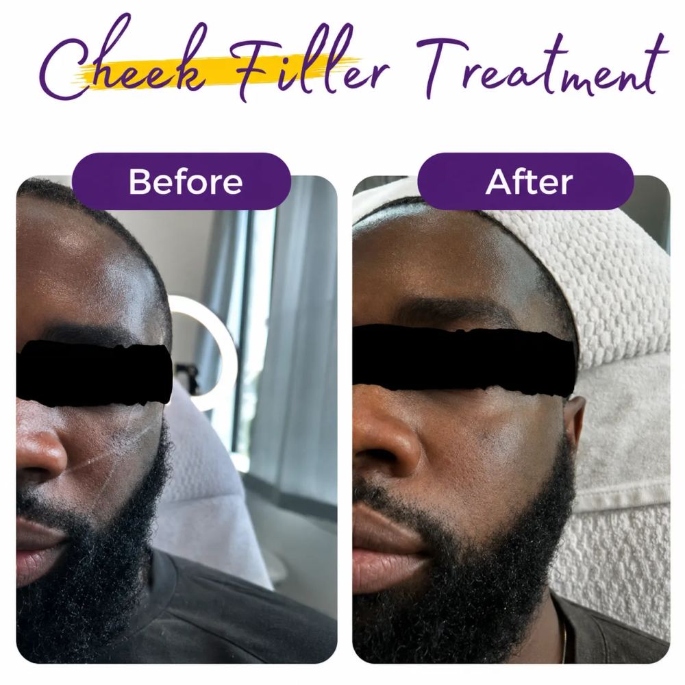 Male patient before and after a facial injectable treatment at Skinovation Aesthetics