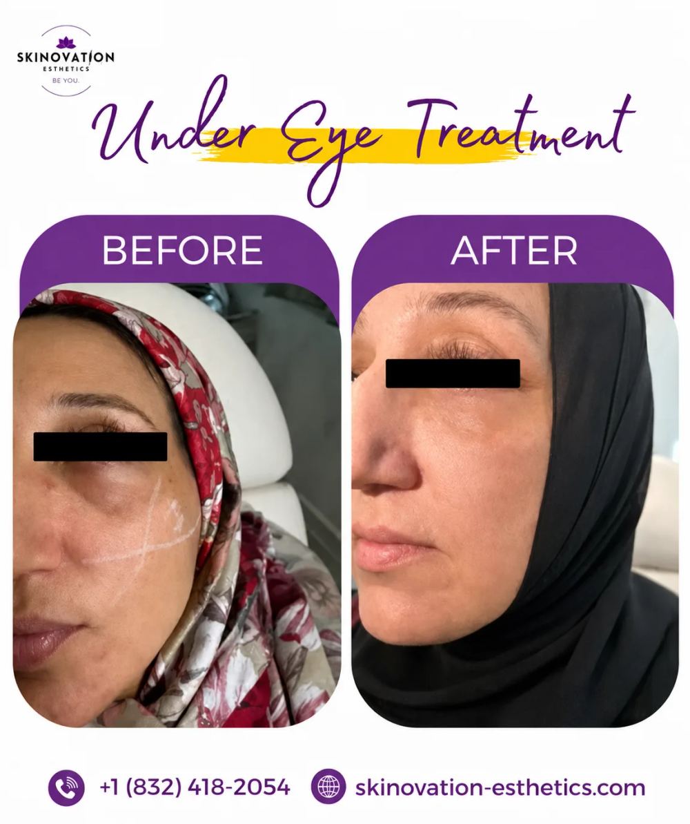 Before-and-after results from a personalized facial injectable treatment at Skinovation Aesthetics