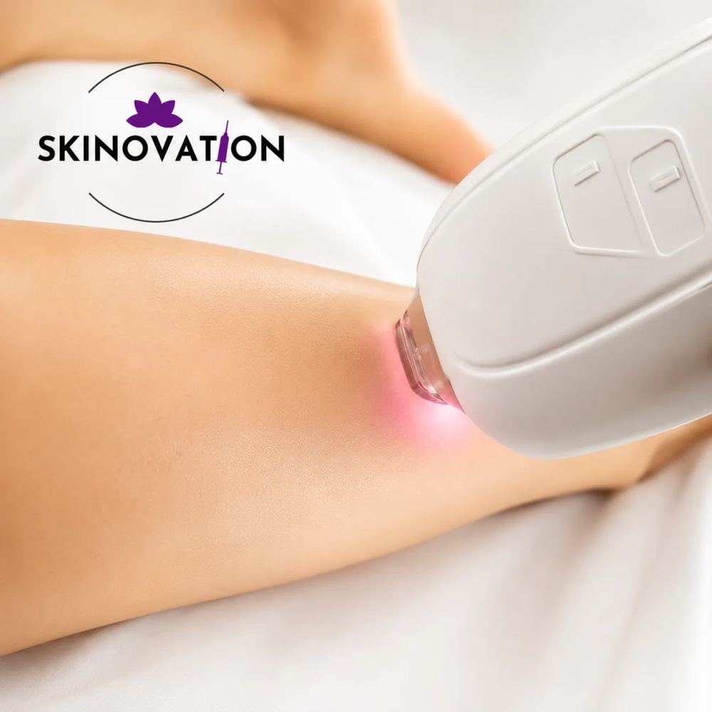 Laser hair removal treatment using a handheld laser device on the skin at Skinovation Aesthetics