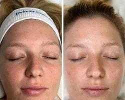 Glowing skin after oxygen facial at Skinovation Aesthetics Katy TX