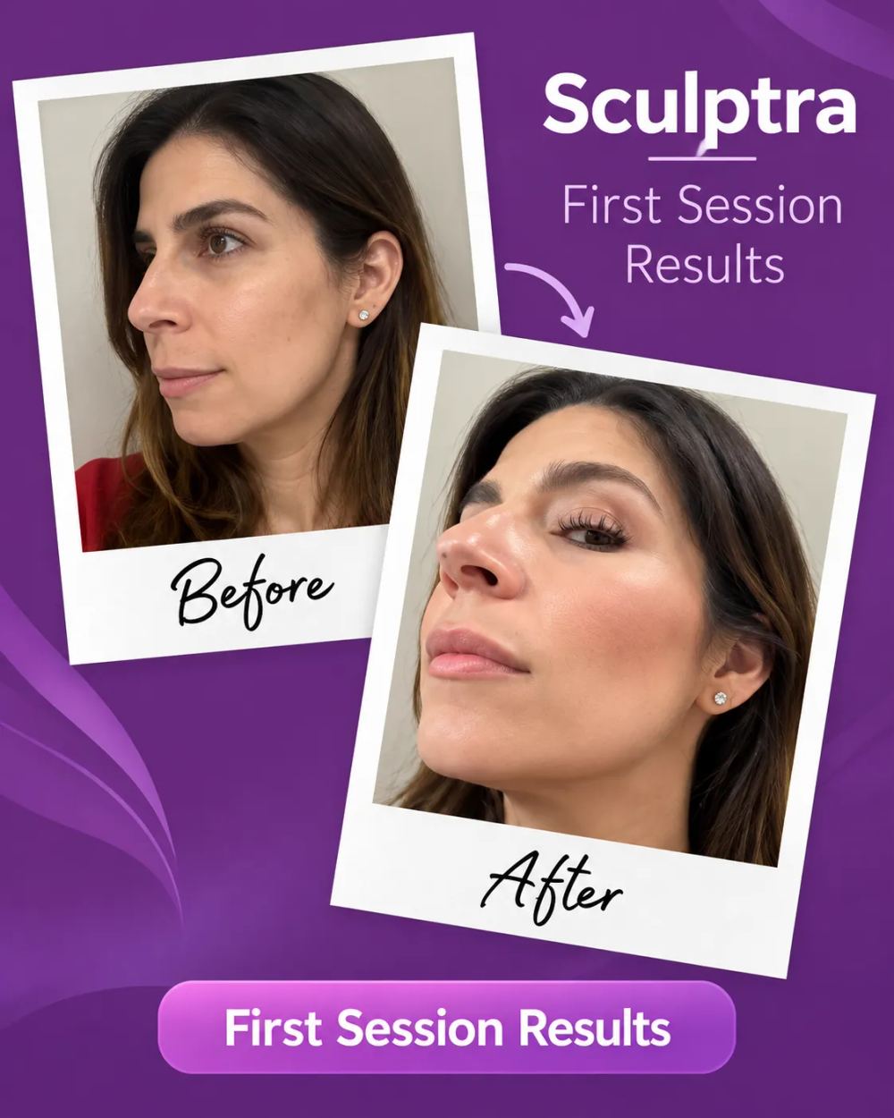 Sculptra first-session before and after showing improved facial contours from a side angle