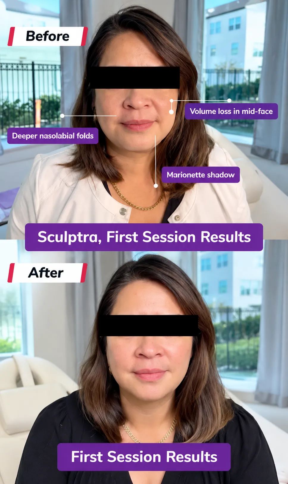 Sculptra before and after showing first-session facial volume and contour results